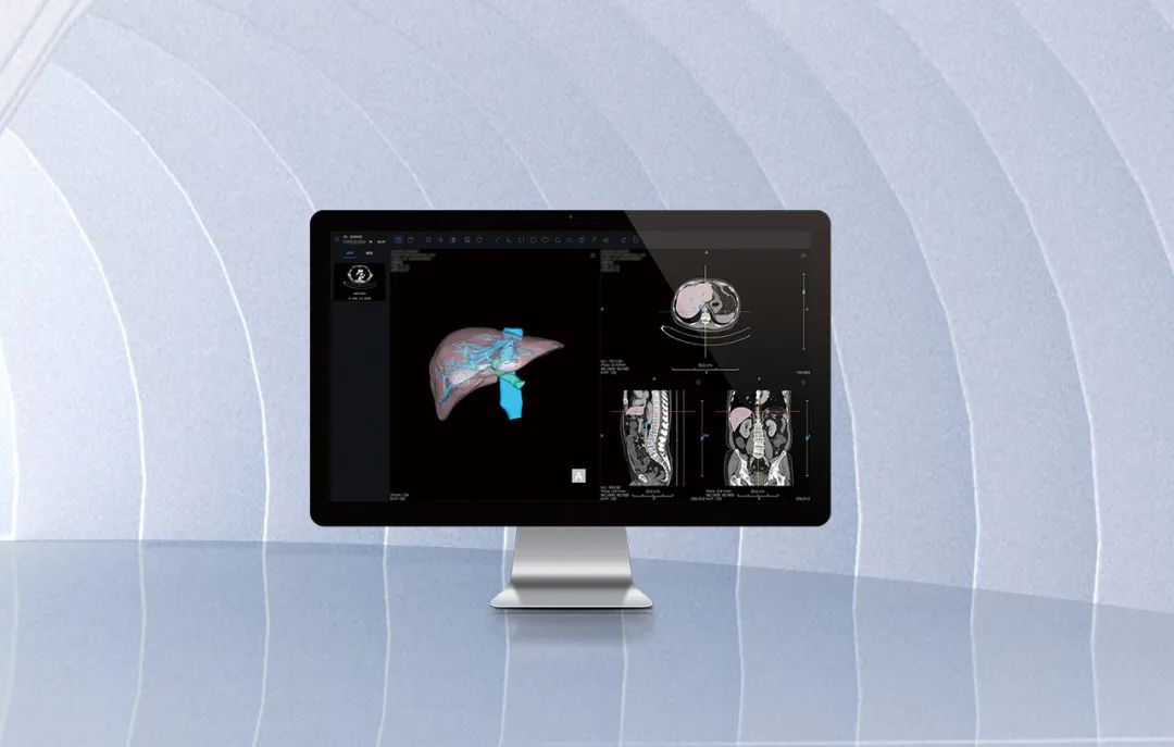 北京市首款!海杰亞醫療自主研發的AI+肝臟CT影像處理軟件獲批上市!